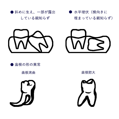 抜歯の難しい親知らずの例